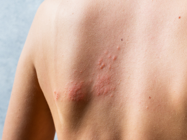 O Herpes-zóster é uma manifestação tardia do mesmo vírus causador da catapora