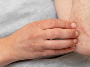 ‘Dia Mundial da Urticária’: entenda a doença e saiba como prevenir crises