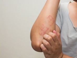 Estudo revela alto risco de alergias alimentares entre calouros: nozes e amendoim lideram reações em cant